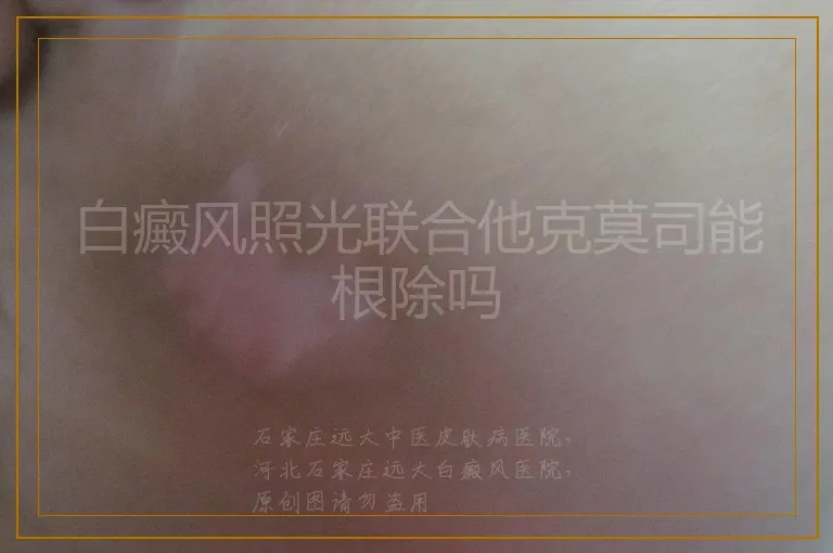 白癜风照光联合他克莫司能根除吗