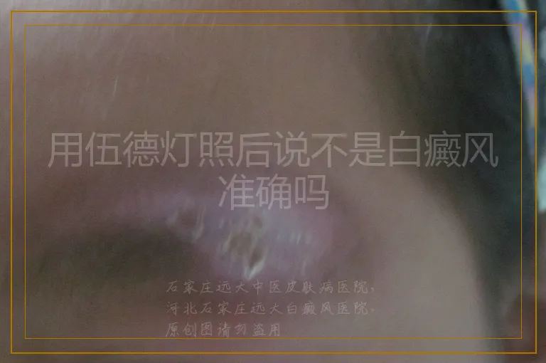 用伍德灯照后说不是白癜风准确吗