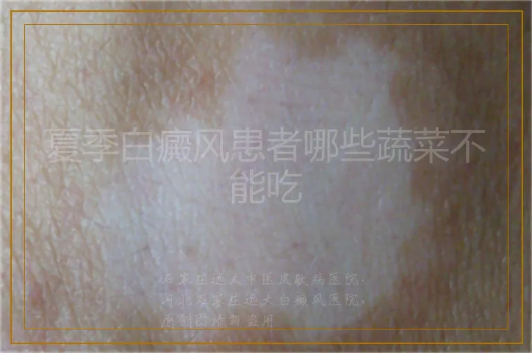 夏季白癜风患者哪些蔬菜不能吃