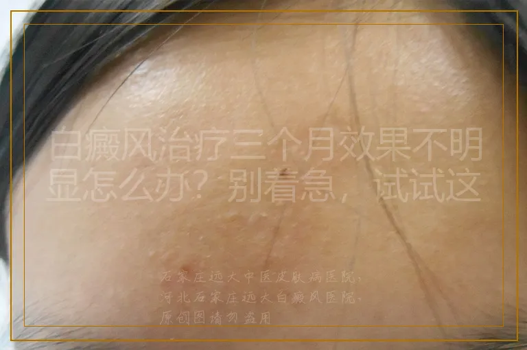 白癜风治疗三个月效果不明显怎么办?别着急,试试这些调整思路