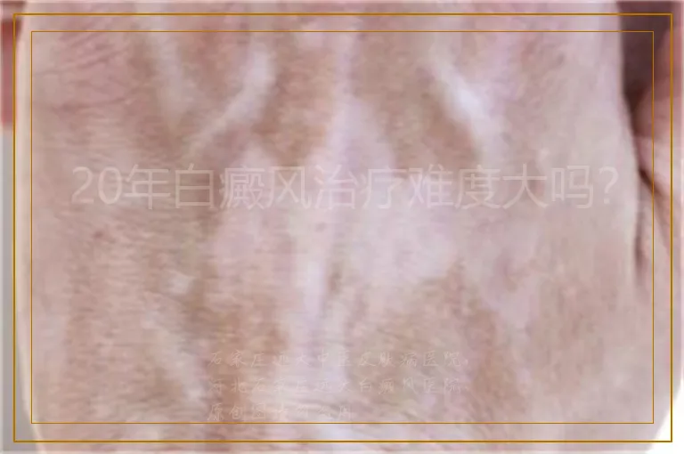 20年白癜风治疗难度大吗？