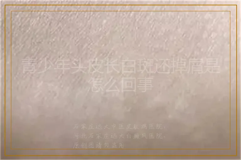 青少年头皮长白斑还掉屑是怎么回事