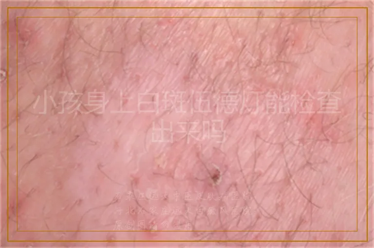 小孩身上白斑伍德灯能检查出来吗
