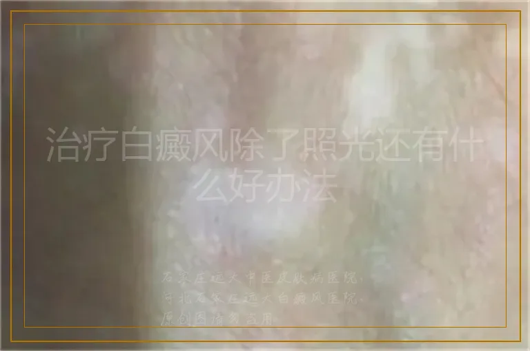 治疗白癜风除了照光还有什么好办法