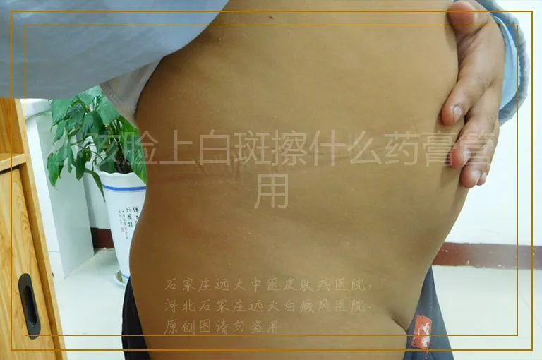 小孩脸上白斑擦什么药膏管用