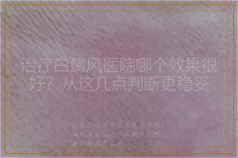 治疗白癜风医院哪个效果很好？从这几点判断更稳妥