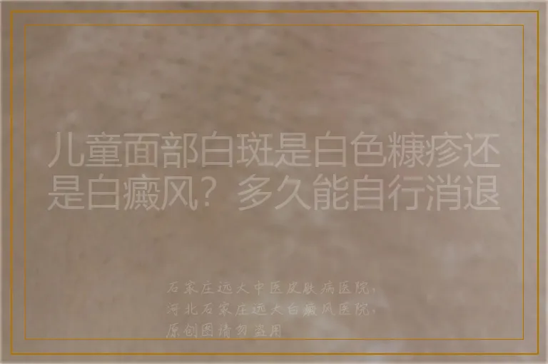 儿童面部白斑是白色糠疹还是白癜风?多久能自行消退