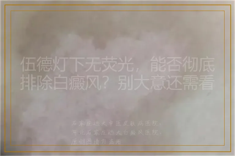 伍德灯下无荧光，能否彻底排除白癜风？别大意还需看这几点