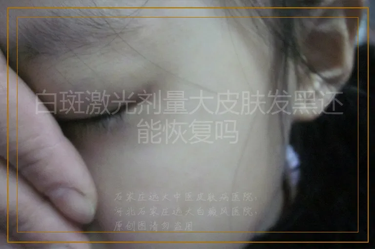 白斑激光剂量大皮肤发黑还能恢复吗