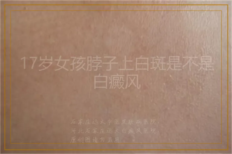 17岁女孩脖子上白斑是不是白癜风