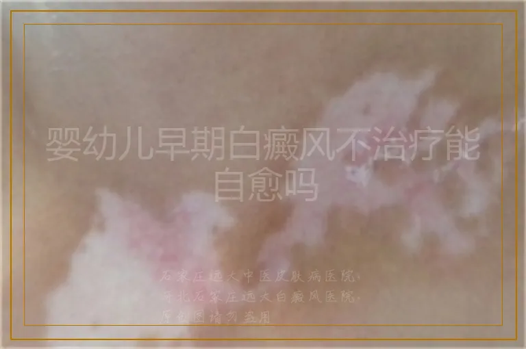 婴幼儿早期白癜风不治疗能自愈吗
