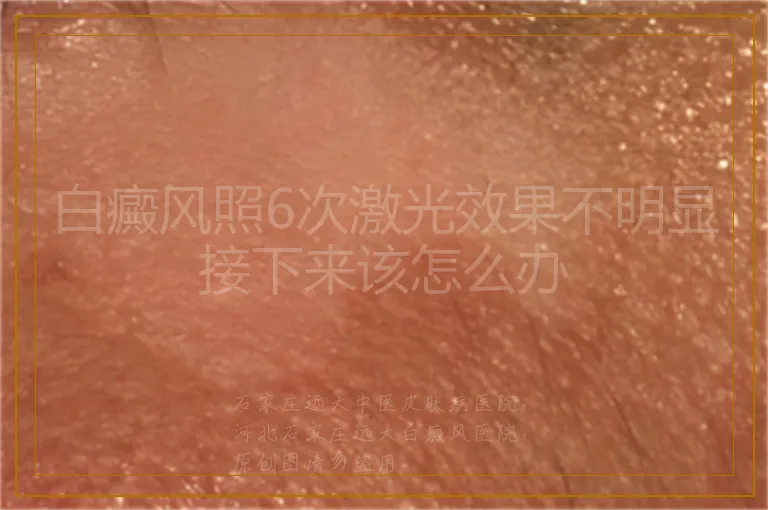 白癜风照6次激光效果不明显接下来该怎么办