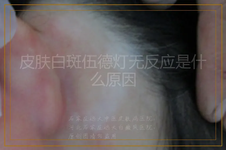 皮肤白斑伍德灯无反应是什么原因