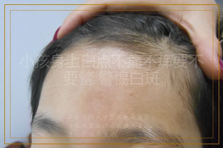 小孩身上白点不痛不痒要不要管 警惕白斑