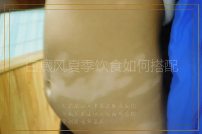 白癜风夏季饮食如何搭配