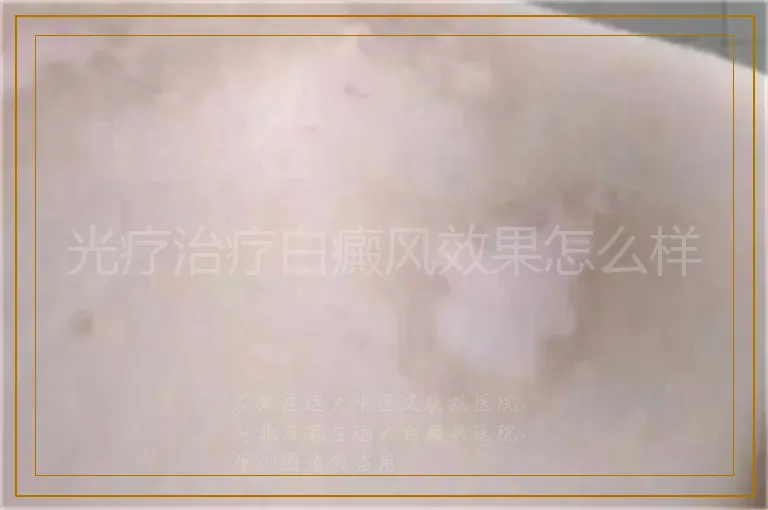 光疗治疗白癜风效果怎么样