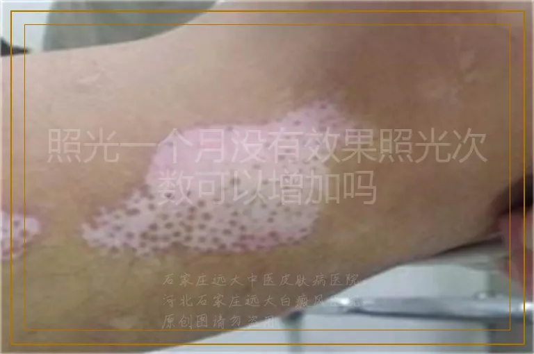 照光一个月没有效果照光次数可以增加吗