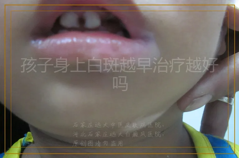 孩子身上白斑越早治疗越好吗