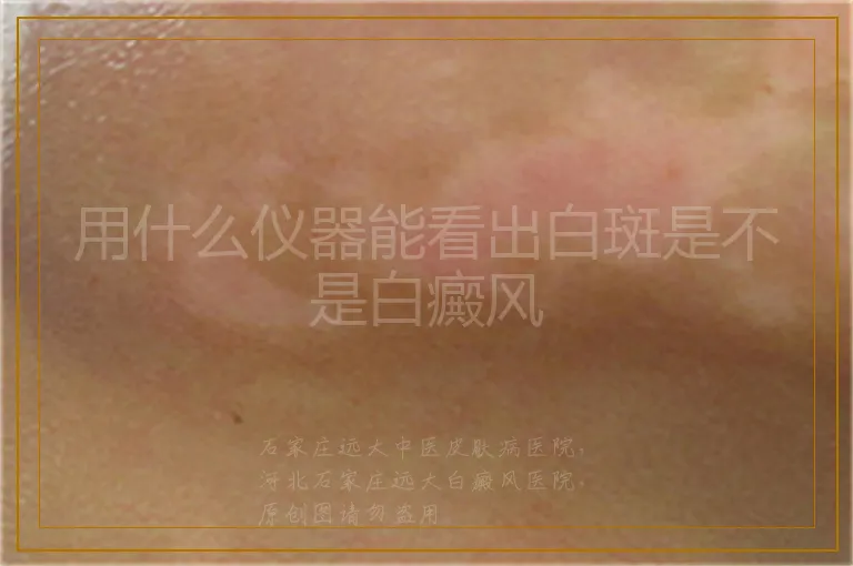 用什么仪器能看出白斑是不是白癜风