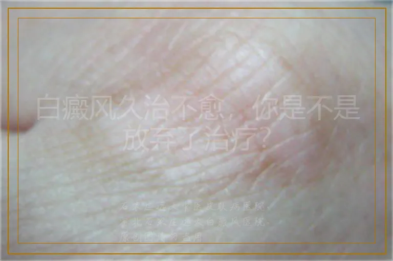 白癜风久治不愈,你是不是放弃了治疗?