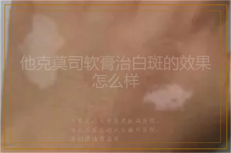 他克莫司软膏治白斑的效果怎么样