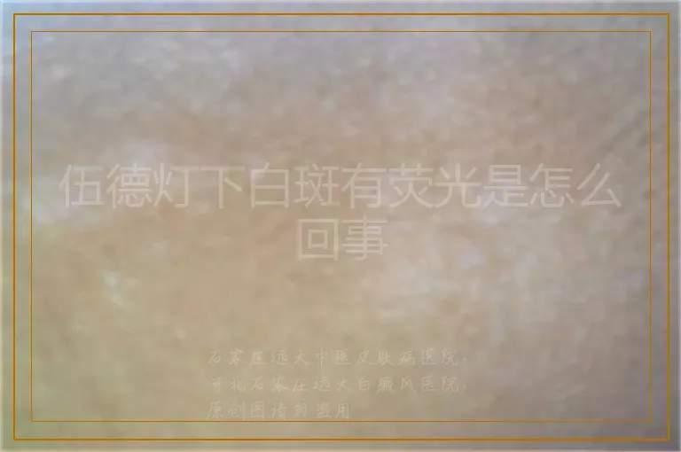 伍德灯下白斑有荧光是怎么回事