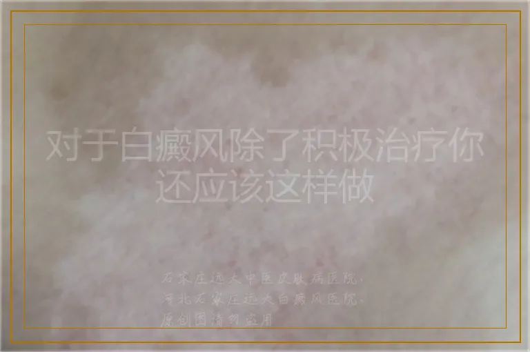 对于白癜风除了积极治疗你还应该这样做