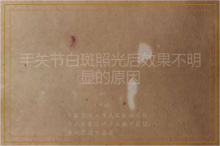 手关节白斑照光后效果不明显的原因
