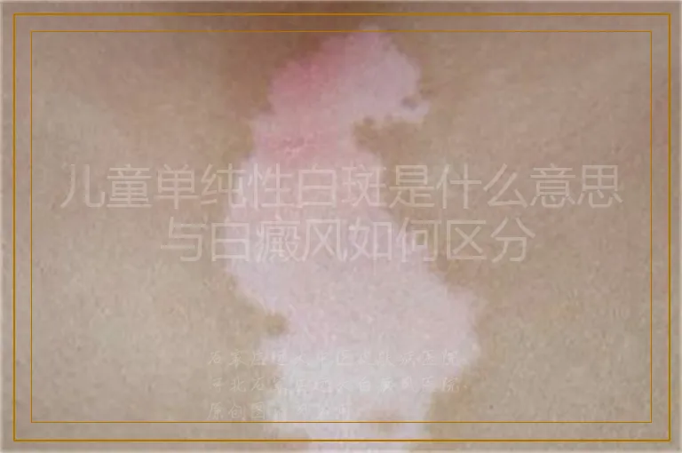 儿童单纯性白斑是什么意思 与白癜风如何区分