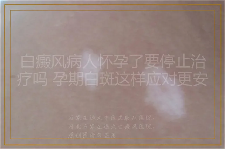 白癜风病人怀孕了要停止治疗吗 孕期白斑这样应对更安心