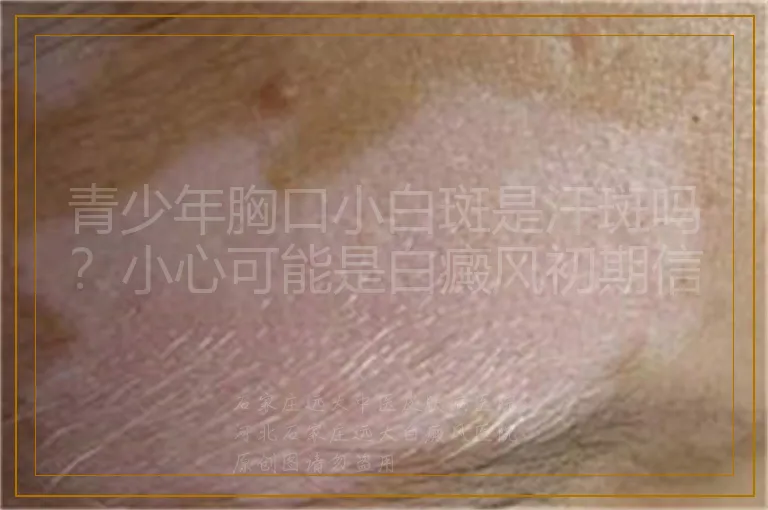 青少年胸口小白斑是汗斑吗?小心可能是白癜风初期信号