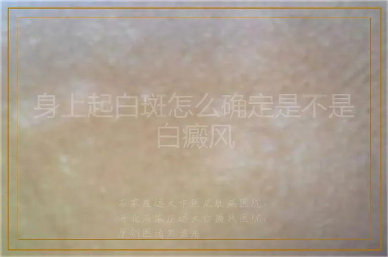 身上起白斑怎么确定是不是白癜风