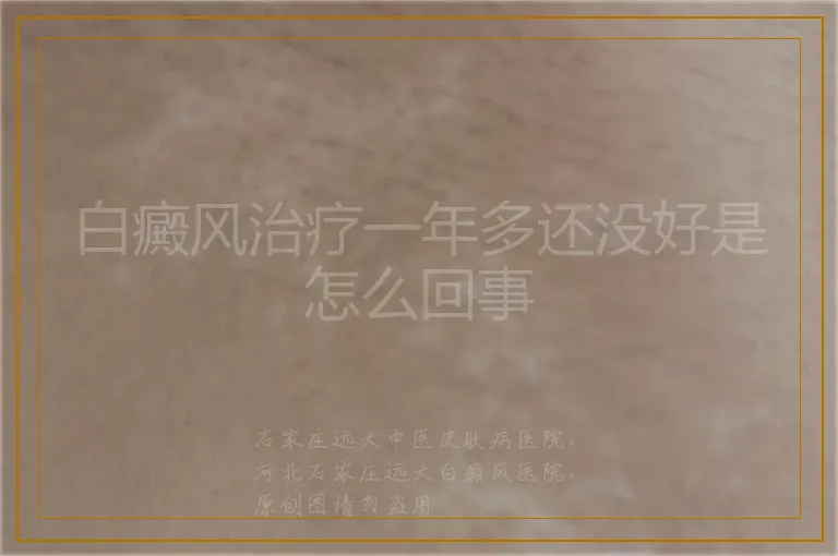 白癜风治疗一年多还没好是怎么回事