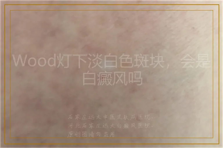 Wood灯下淡白色斑块，会是白癜风吗