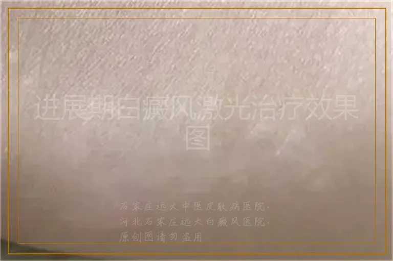 进展期白癜风激光治疗效果图