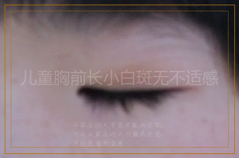 儿童胸前长小白斑无不适感