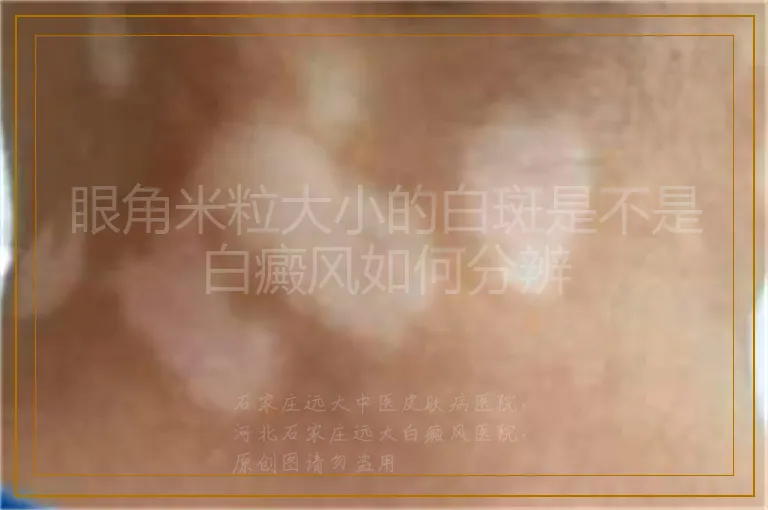 眼角米粒大小的白斑是不是白癜风如何分辨
