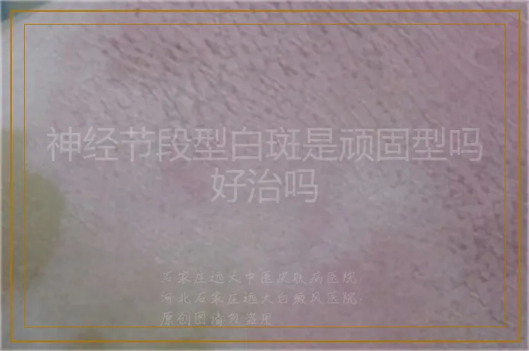 神经节段型白斑是顽固型吗好治吗