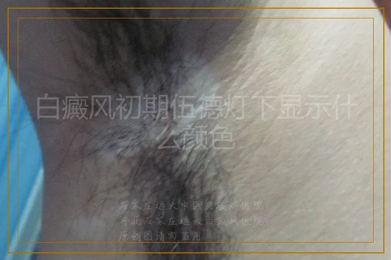 白癜风初期伍德灯下显示什么颜色