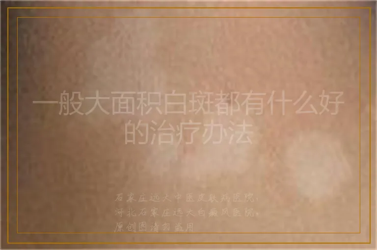 一般大面积白斑都有什么好的治疗办法