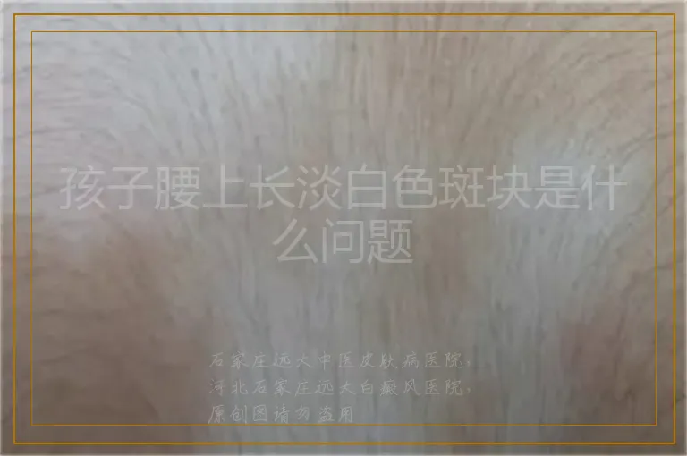 孩子腰上长淡白色斑块是什么问题