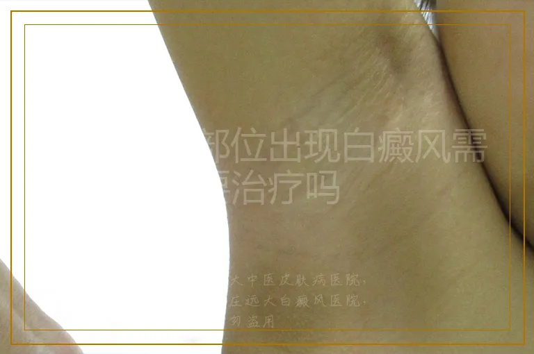 儿童隐私部位出现白癜风需要治疗吗