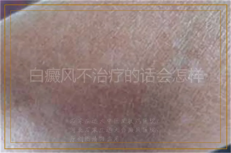 白癜风不治疗的话会怎样