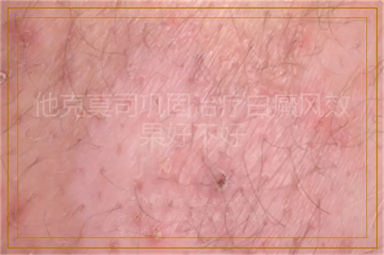 他克莫司巩固治疗白癜风效果好不好