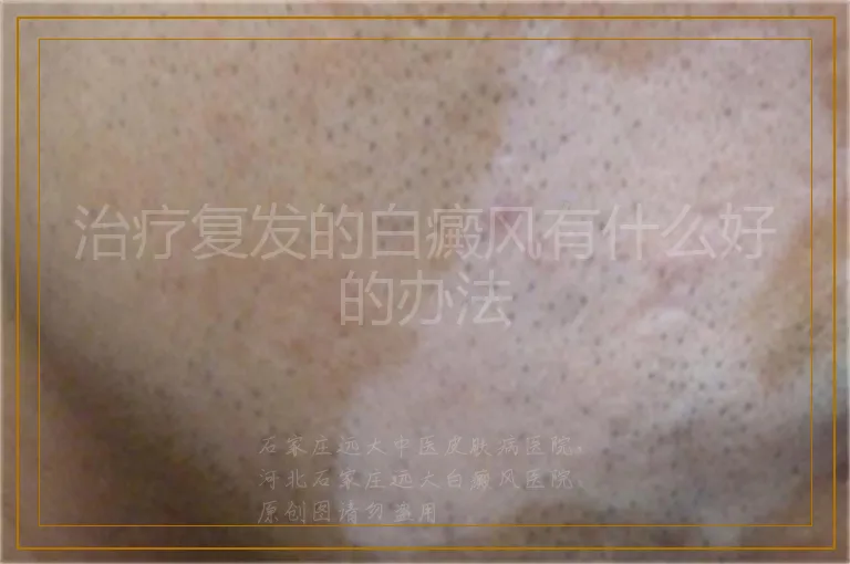 治疗复发的白癜风有什么好的办法