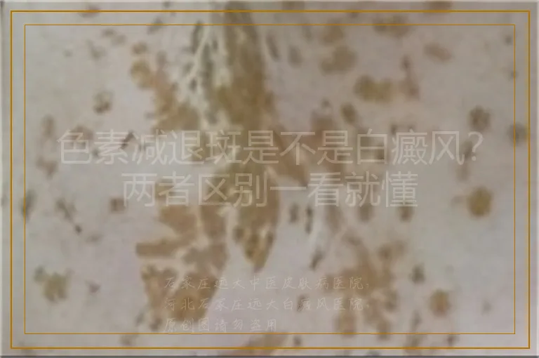 色素减退斑是不是白癜风?两者区别一看就懂