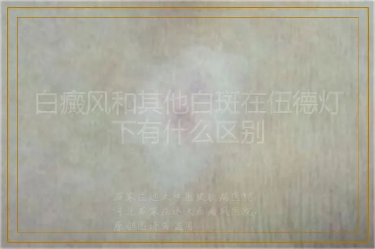 白癜风和其他白斑在伍德灯下有什么区别