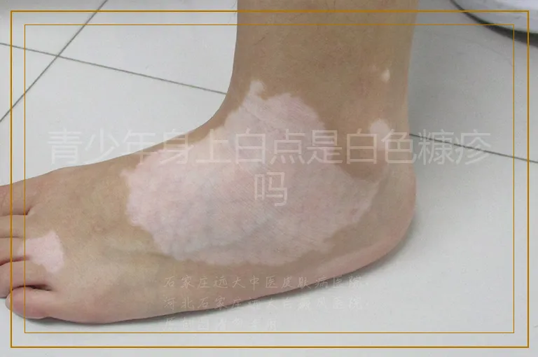 青少年身上白点是白色糠疹吗