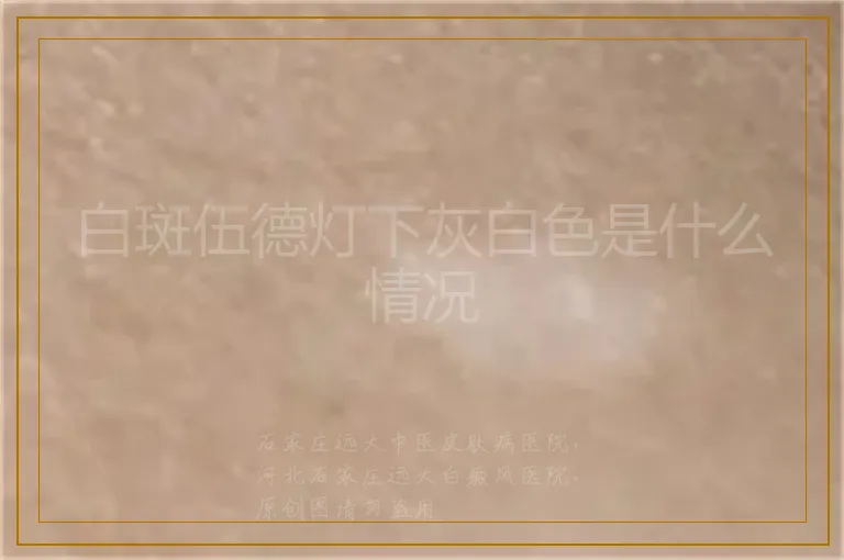 白斑伍德灯下灰白色是什么情况