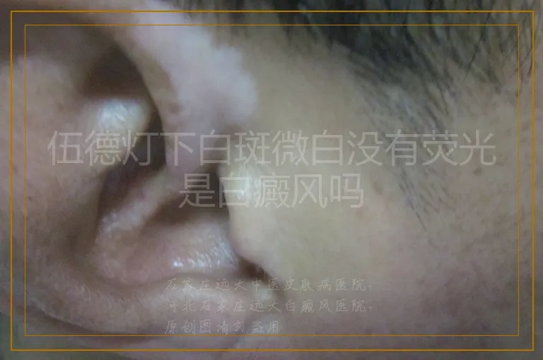 伍德灯下白斑微白没有荧光是白癜风吗